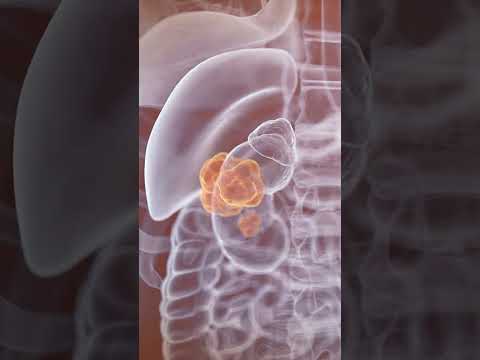 PET-CT Scan for Cancer: What Patients Should Know | Doctor Explains